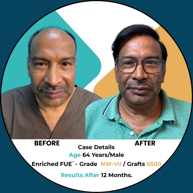 hair transplant results