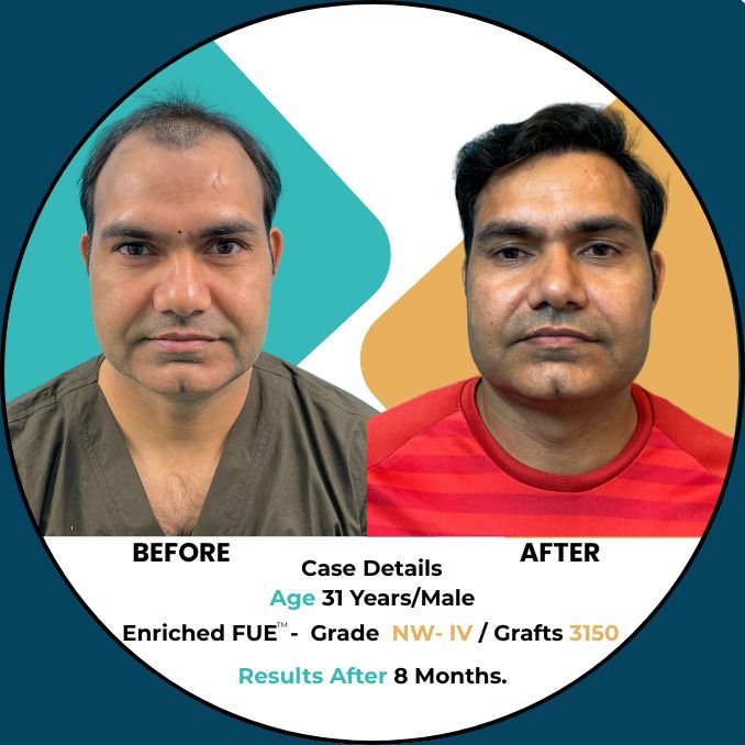 hair transplant results