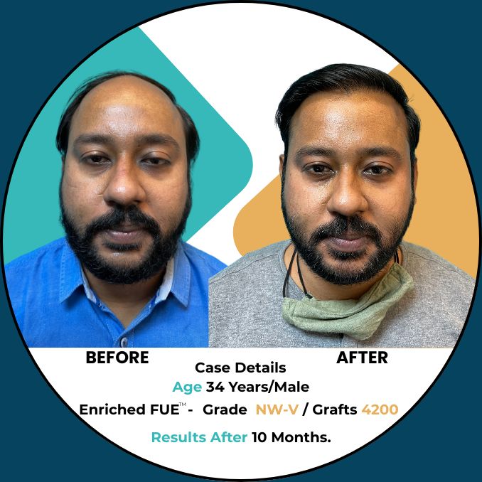 hair transplant result